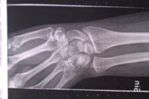 min röntgade hand
